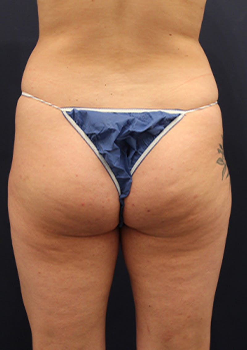 Liposuction Before & After Gallery - Patient 174199605 - Image 4