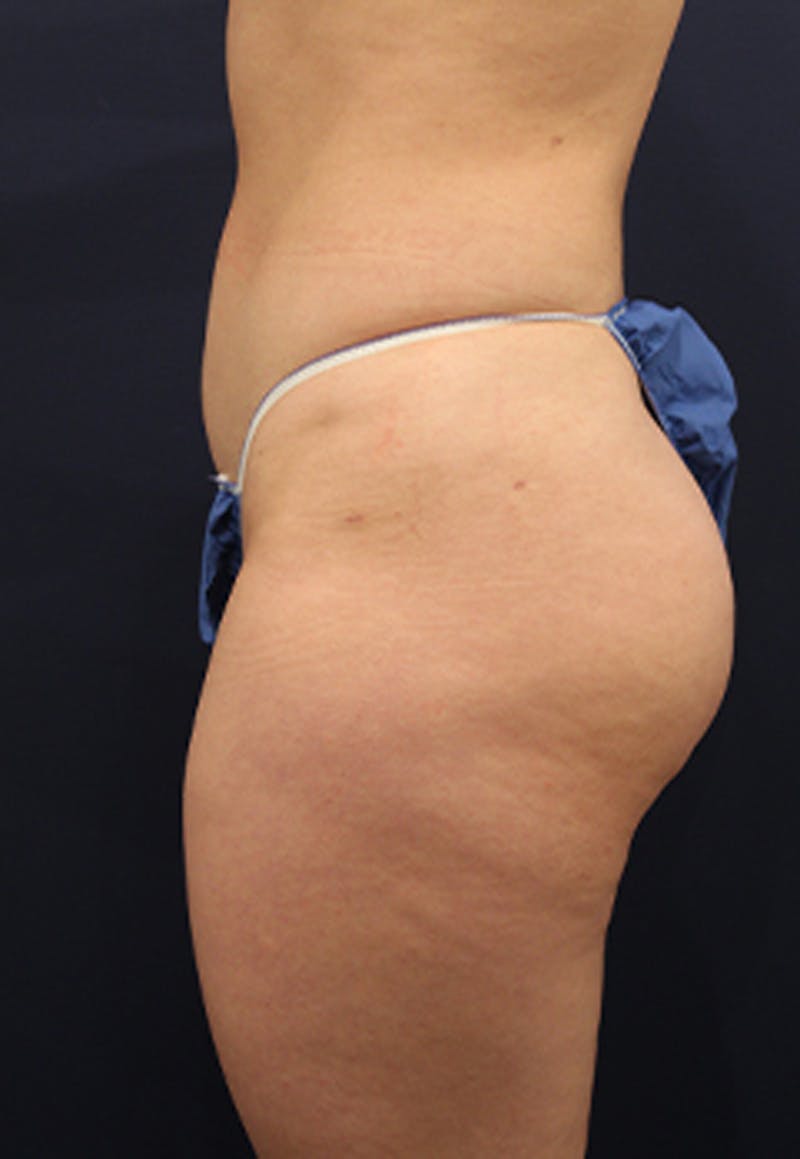 Liposuction Before & After Gallery - Patient 174199605 - Image 7