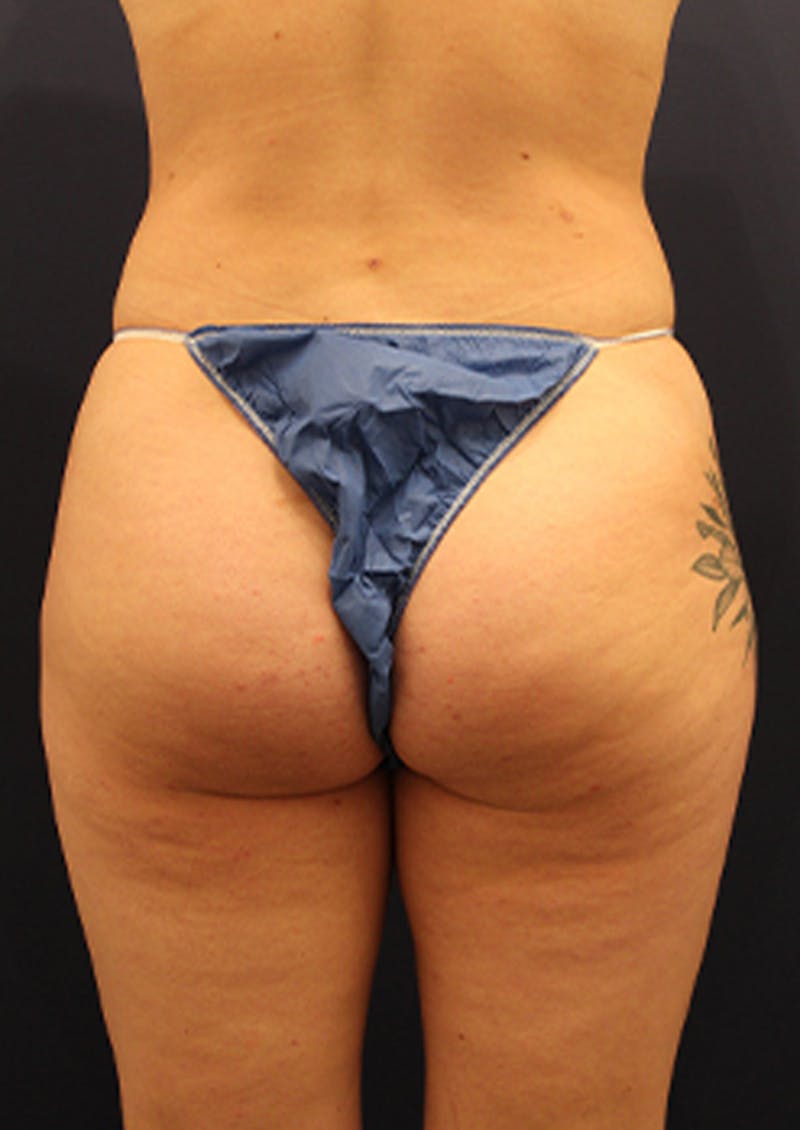 Liposuction Before & After Gallery - Patient 174199605 - Image 8