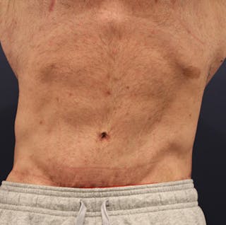 Massive Weight Loss Before & After Gallery - Patient 174160973 - Image 2