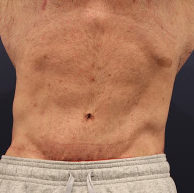 Massive Weight Loss Before & After Gallery - Patient 174160973 - Image 2