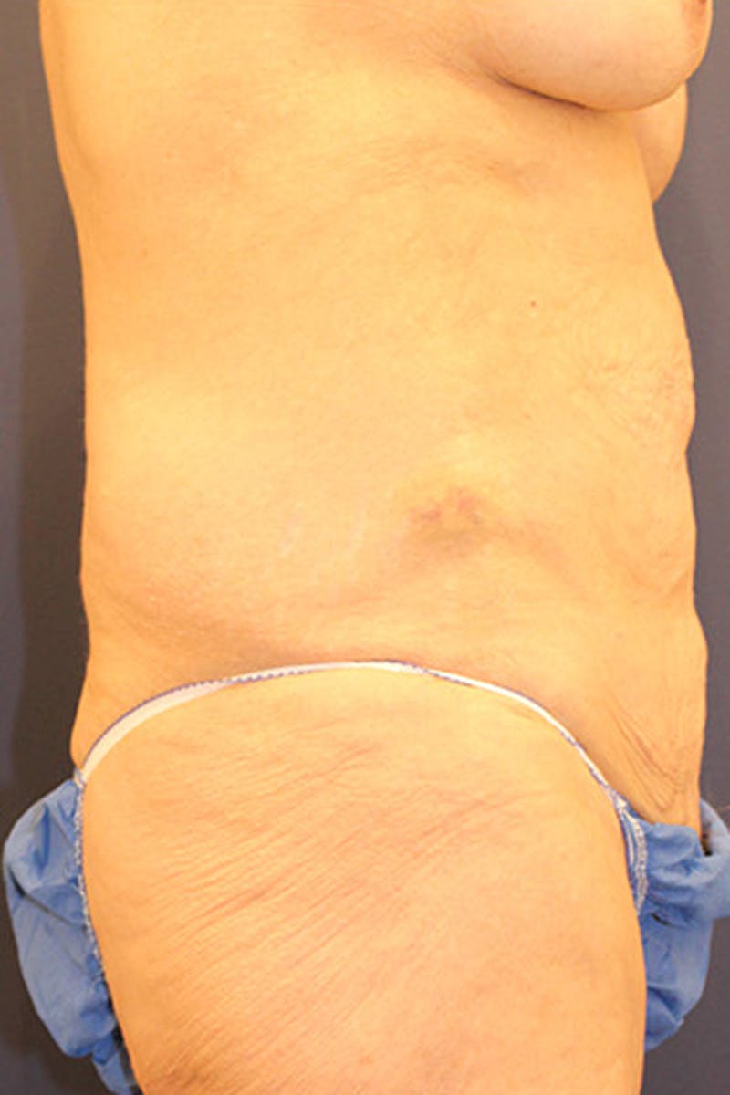 Massive Weight Loss Before & After Gallery - Patient 174162053 - Image 3