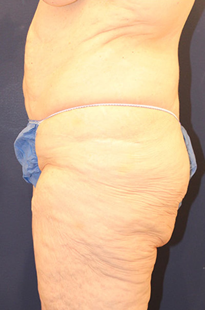 Massive Weight Loss Before & After Gallery - Patient 174162059 - Image 4