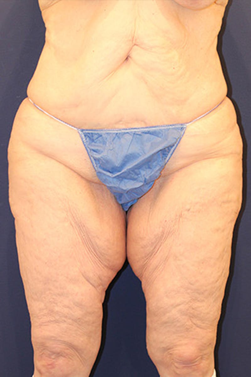 Massive Weight Loss Before & After Gallery - Patient 174162059 - Image 1