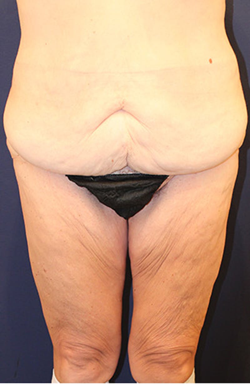 Massive Weight Loss Before & After Gallery - Patient 174162064 - Image 1