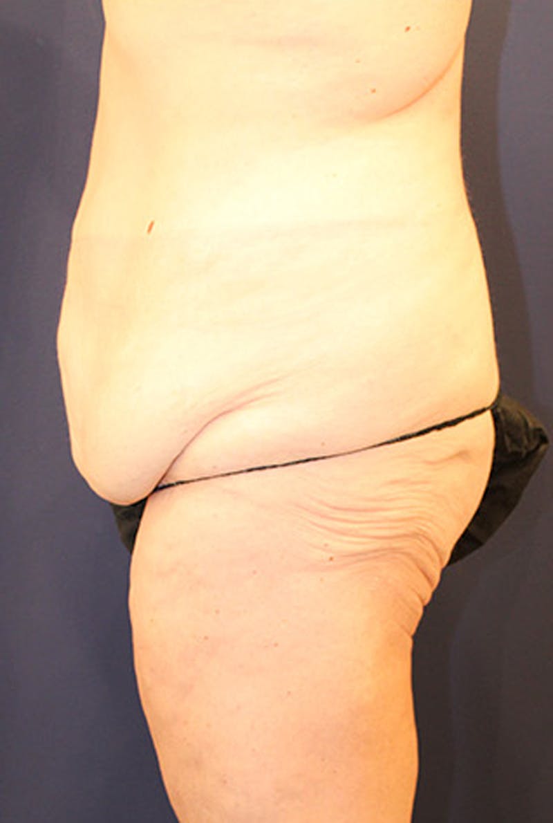 Massive Weight Loss Before & After Gallery - Patient 174162064 - Image 3