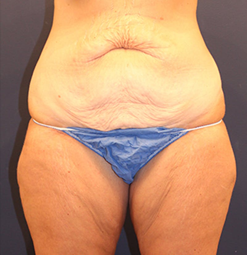 Massive Weight Loss Before & After Gallery - Patient 174162074 - Image 1