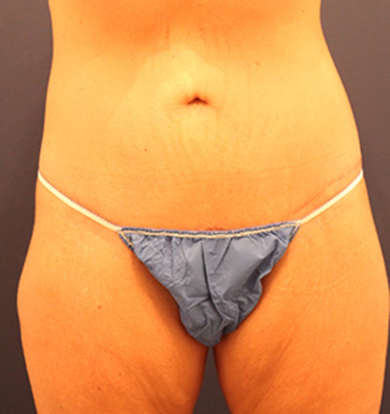 Massive Weight Loss Before & After Gallery - Patient 174162074 - Image 2