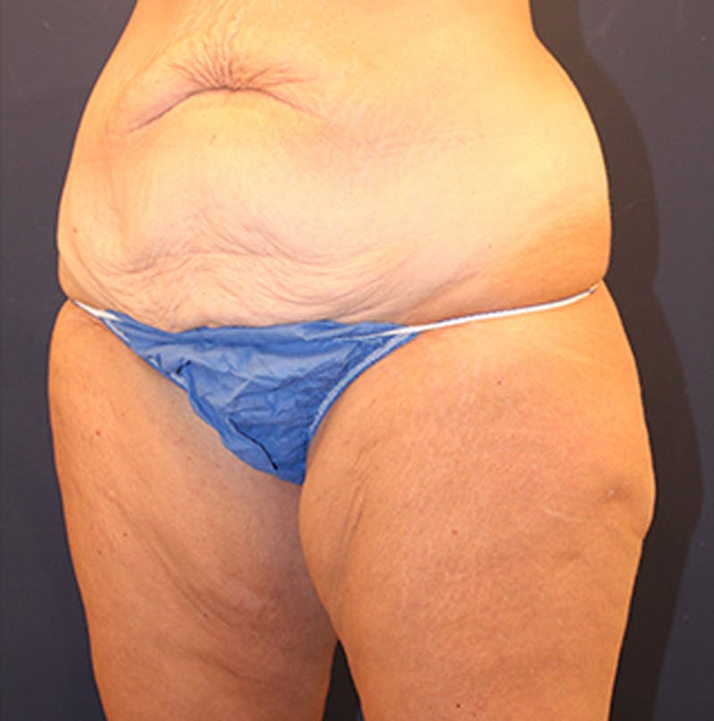Massive Weight Loss Before & After Gallery - Patient 174162074 - Image 3