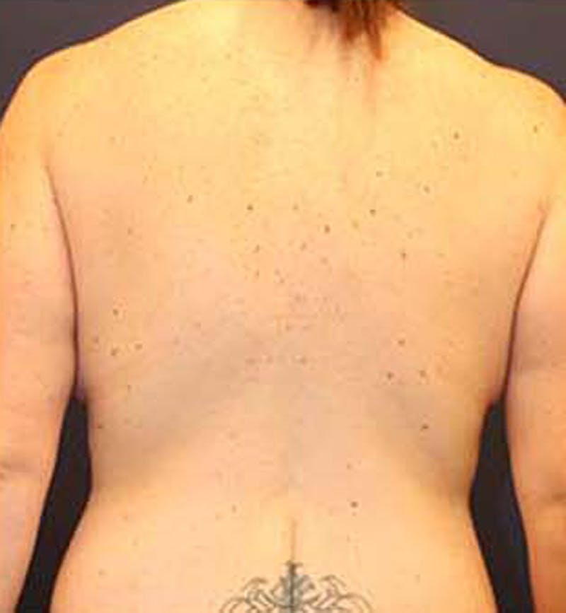 Massive Weight Loss Before & After Gallery - Patient 174163157 - Image 8