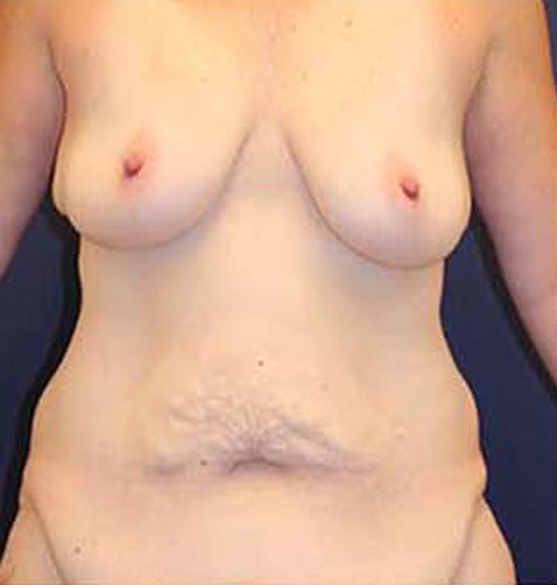 Massive Weight Loss Before & After Gallery - Patient 174163157 - Image 1
