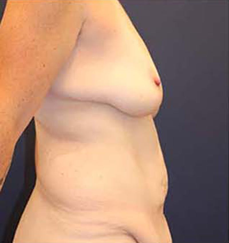 Massive Weight Loss Before & After Gallery - Patient 174163157 - Image 5
