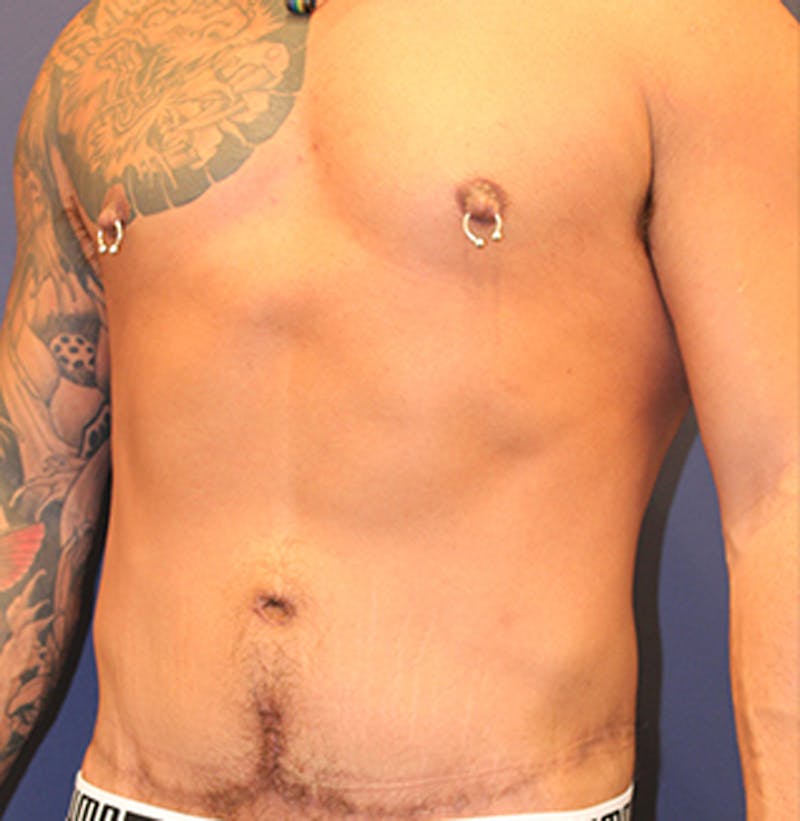 Massive Weight Loss Before & After Gallery - Patient 174163164 - Image 4