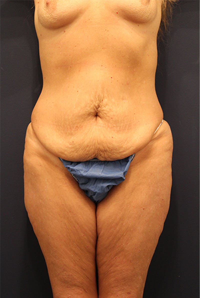 Massive Weight Loss Before & After Gallery - Patient 174163177 - Image 1