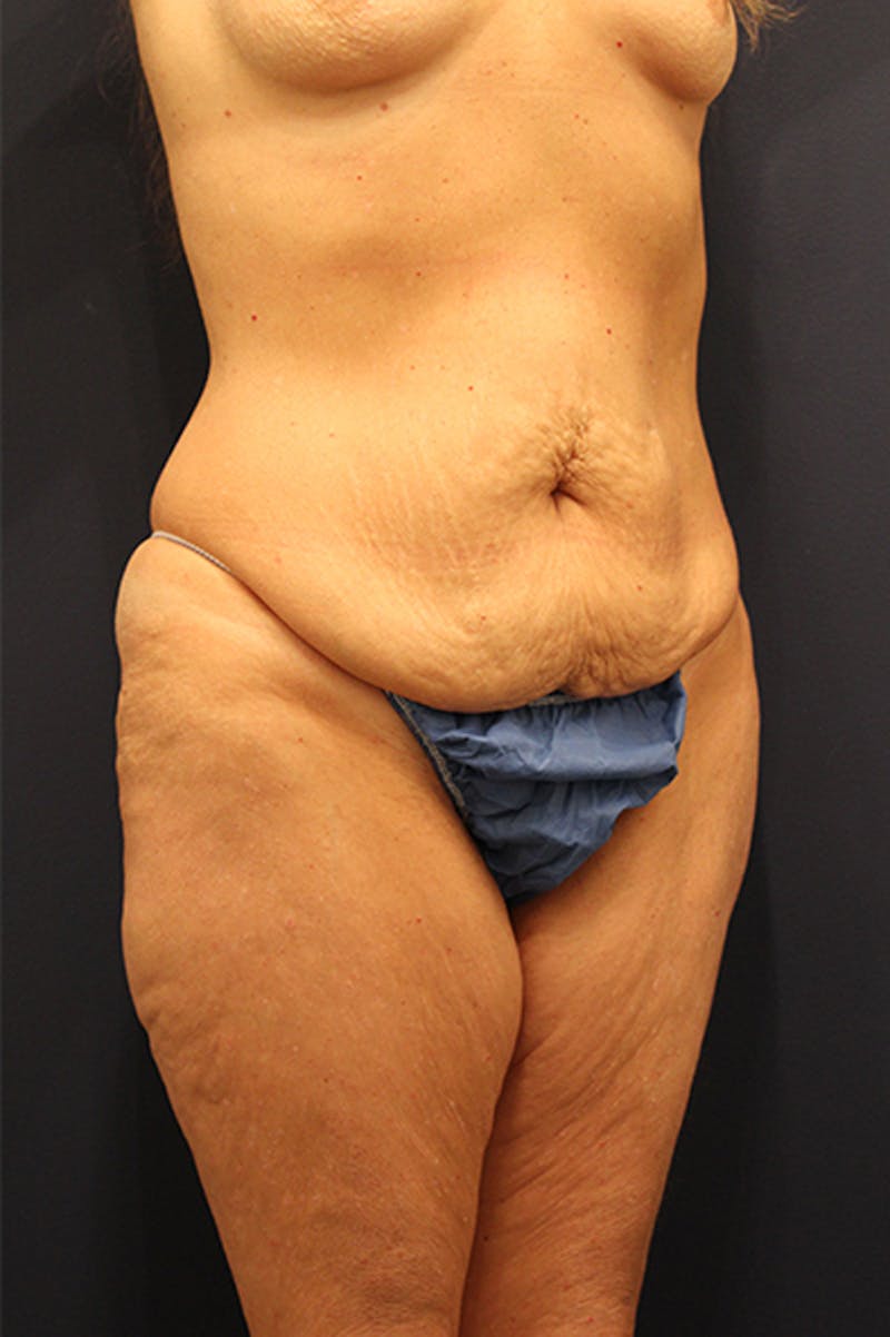 Massive Weight Loss Before & After Gallery - Patient 174163177 - Image 3