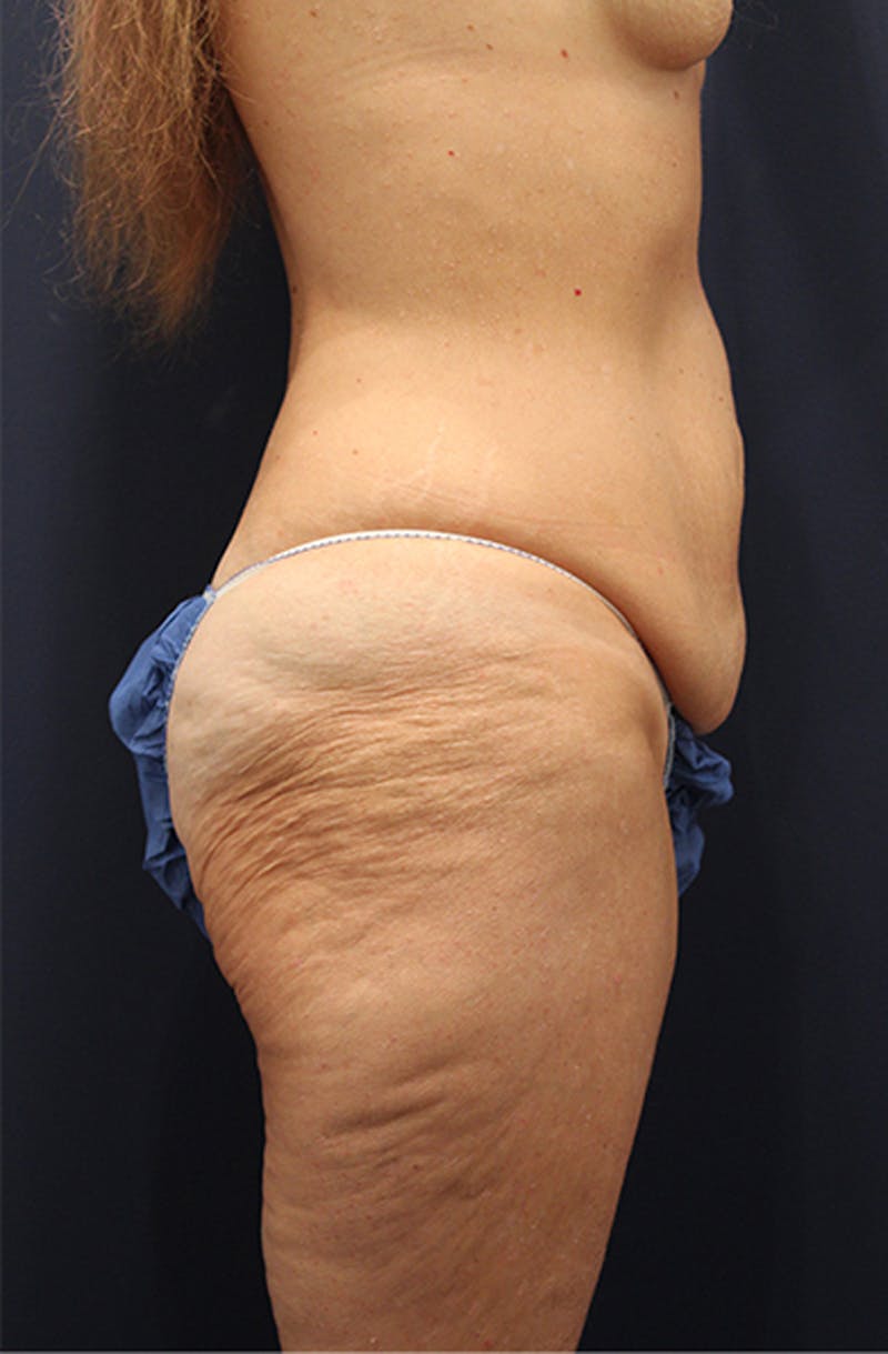 Massive Weight Loss Before & After Gallery - Patient 174163177 - Image 5