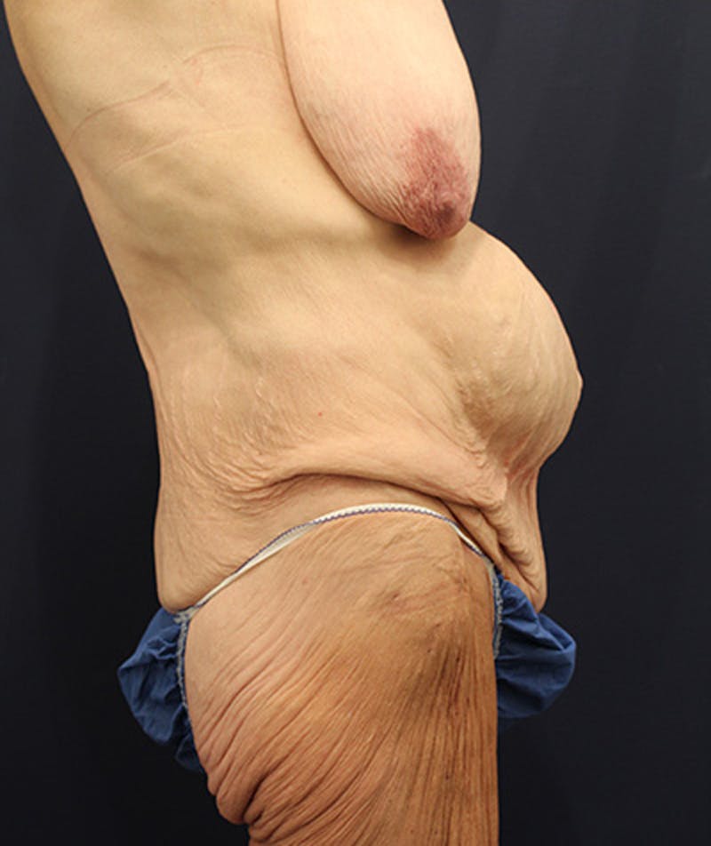 Massive Weight Loss Before & After Gallery - Patient 174163184 - Image 5