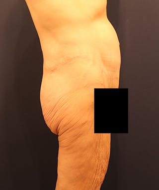 Massive Weight Loss Before & After Gallery - Patient 174163184 - Image 6