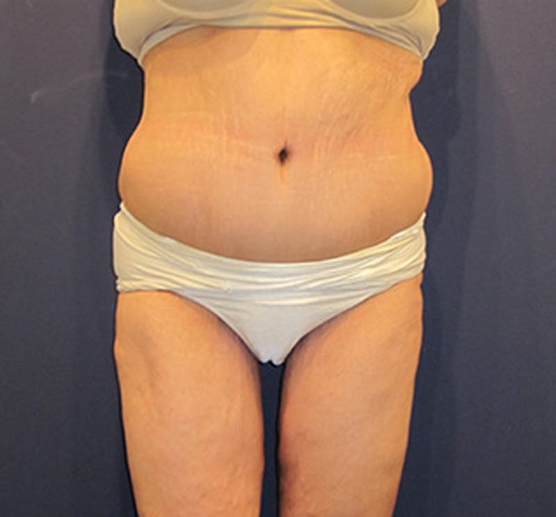 Massive Weight Loss Before & After Gallery - Patient 174163197 - Image 2