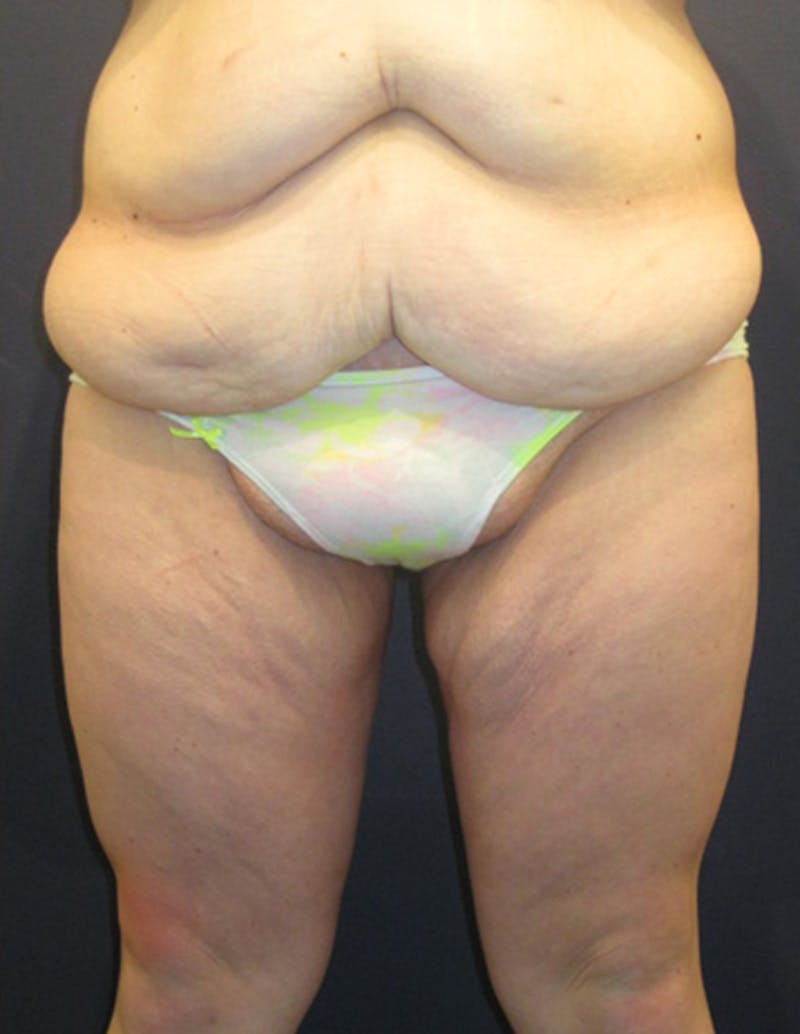 Massive Weight Loss Before & After Gallery - Patient 174163204 - Image 1