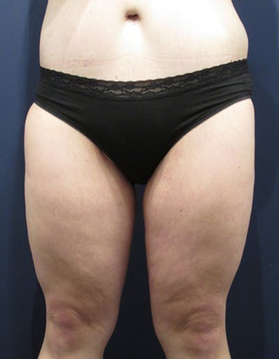 Massive Weight Loss Before & After Gallery - Patient 174163204 - Image 2