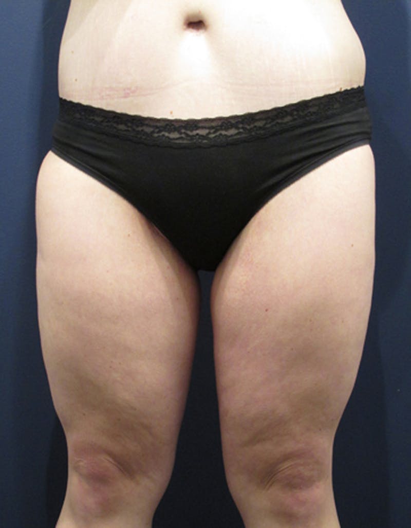 Massive Weight Loss Before & After Gallery - Patient 174163204 - Image 2