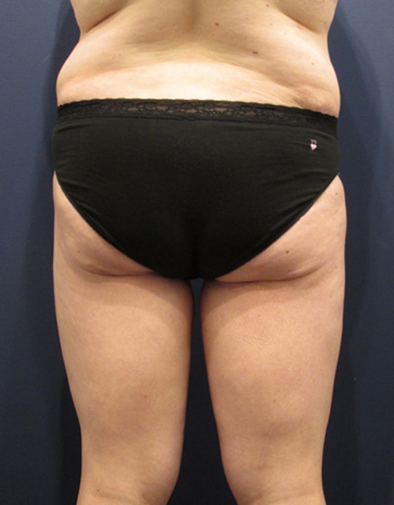 Massive Weight Loss Before & After Gallery - Patient 174163204 - Image 3