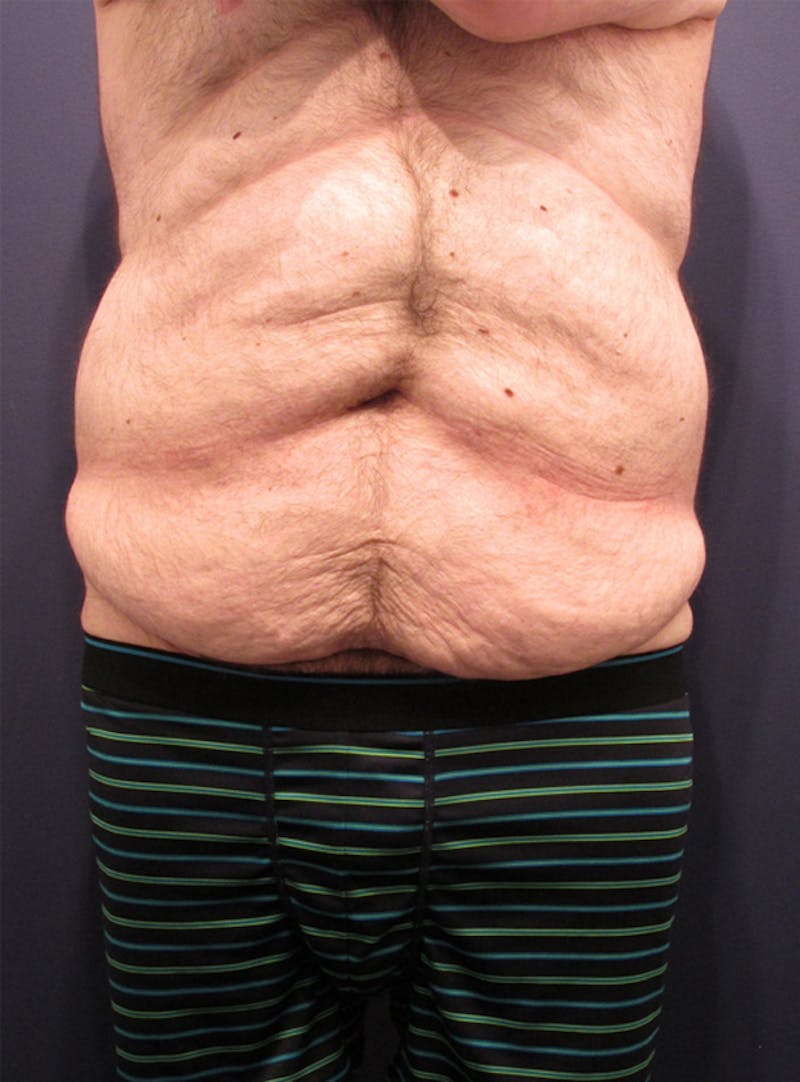 Massive Weight Loss Before & After Gallery - Patient 174163216 - Image 1