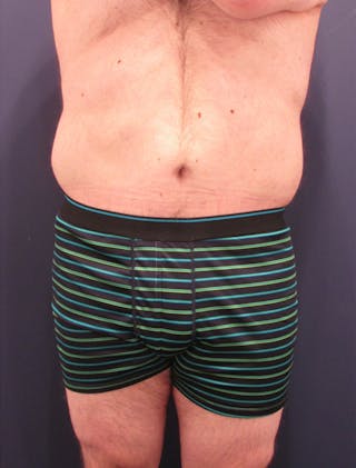 Massive Weight Loss Before & After Gallery - Patient 174163216 - Image 2