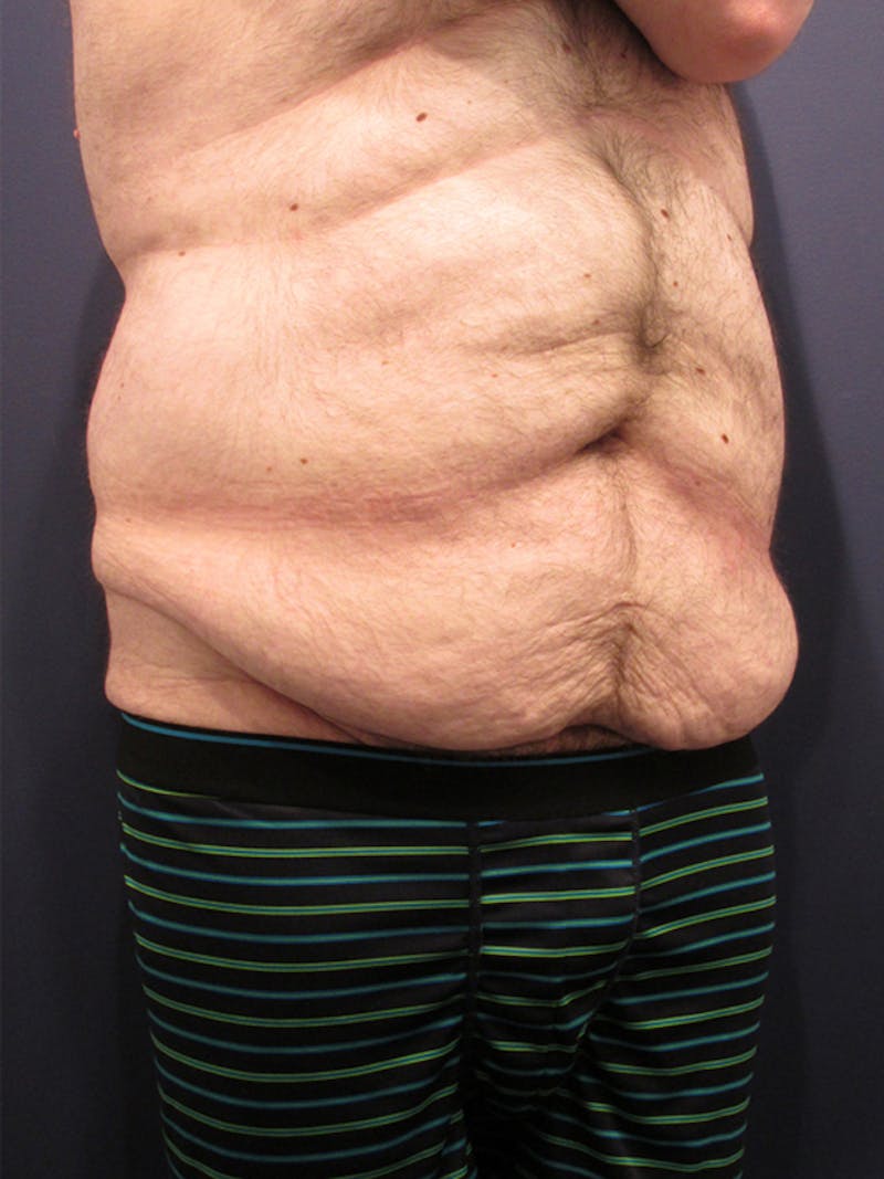Massive Weight Loss Before & After Gallery - Patient 174163216 - Image 3