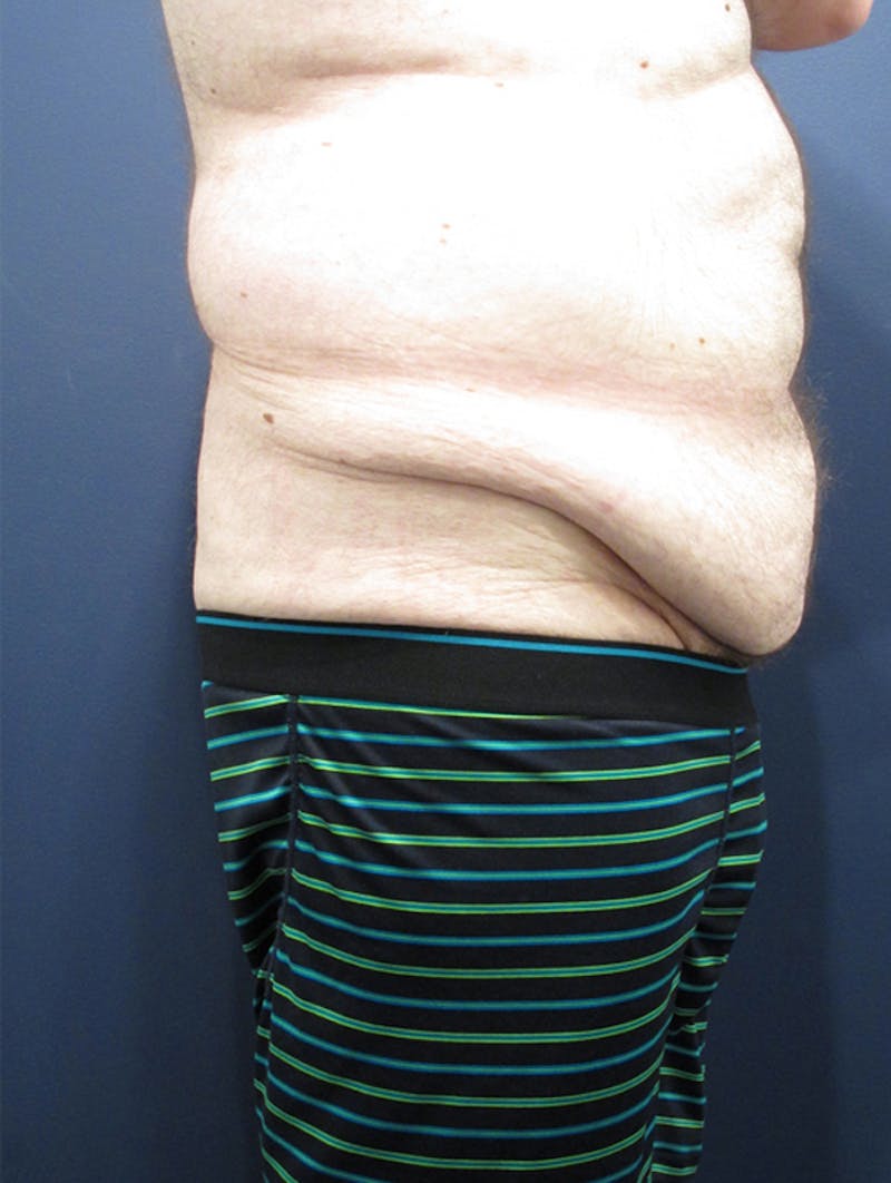 Massive Weight Loss Before & After Gallery - Patient 174163216 - Image 5