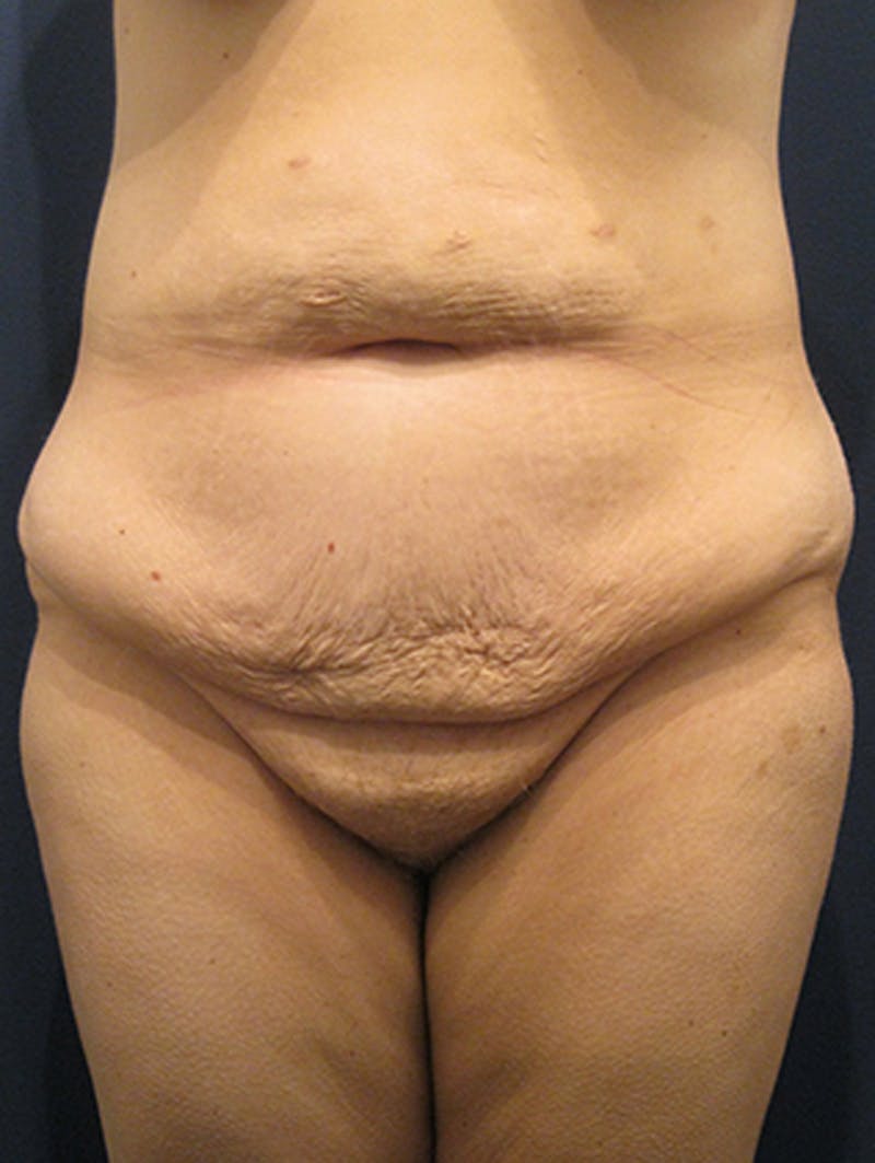 Massive Weight Loss Before & After Gallery - Patient 174163227 - Image 1