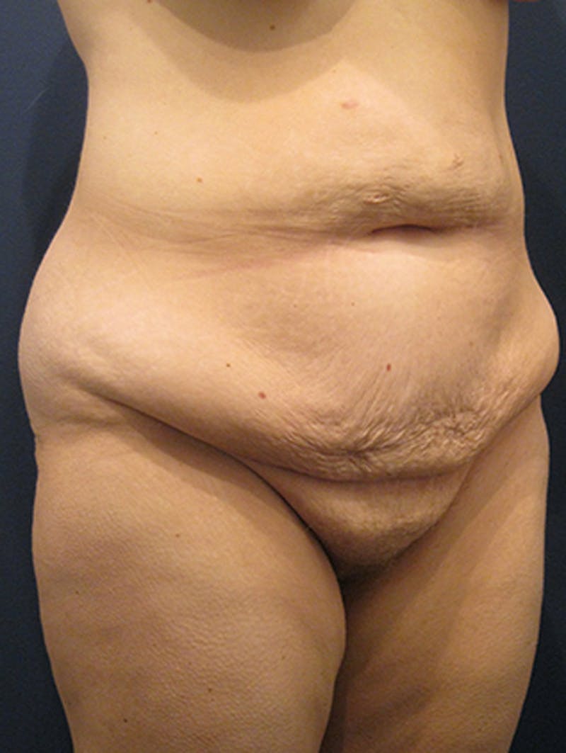 Massive Weight Loss Before & After Gallery - Patient 174163227 - Image 3