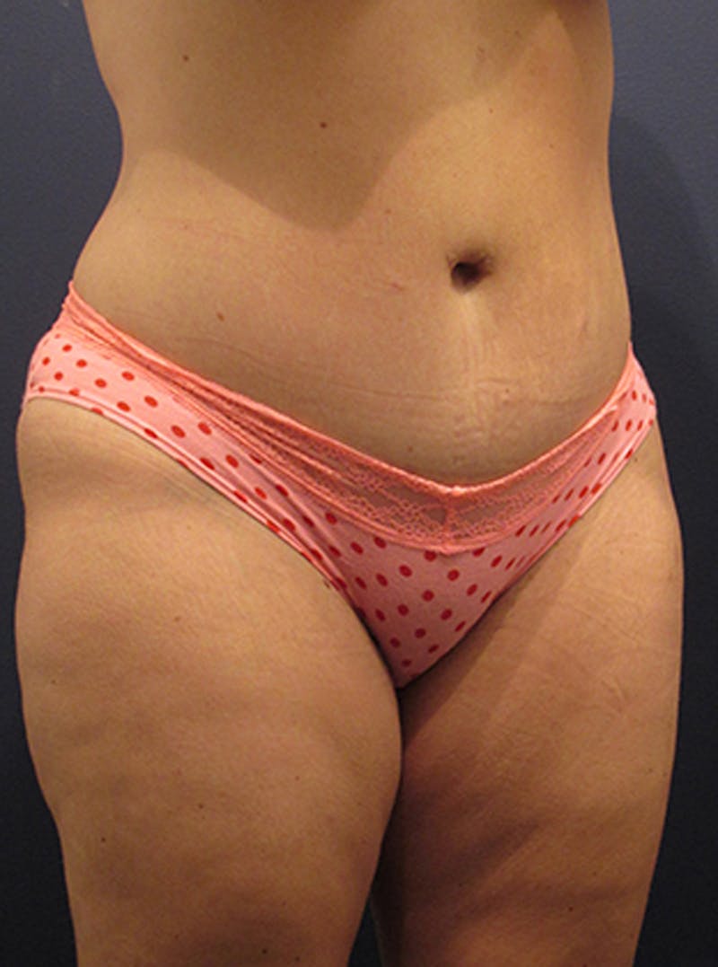 Massive Weight Loss Before & After Gallery - Patient 174163227 - Image 4