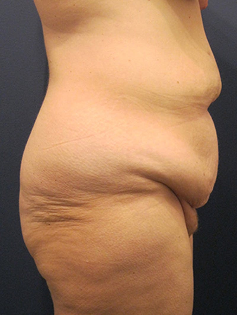 Massive Weight Loss Before & After Gallery - Patient 174163227 - Image 5