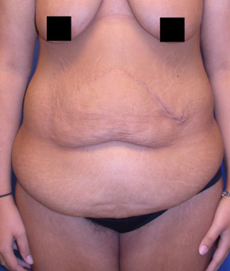 Massive Weight Loss Before & After Gallery - Patient 174163236 - Image 1