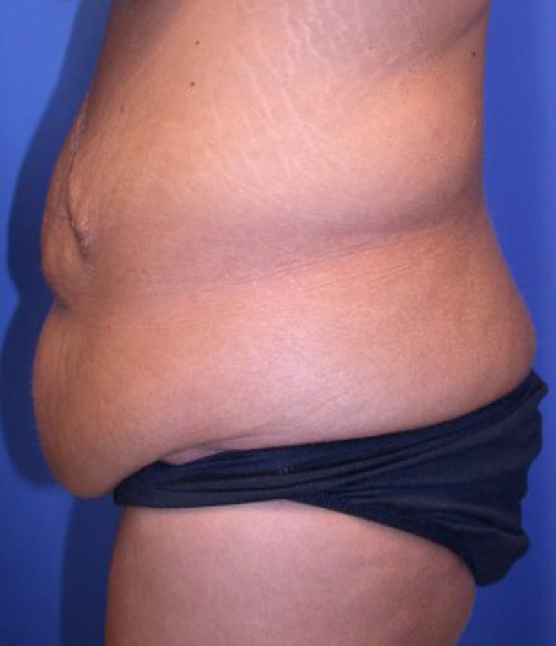 Massive Weight Loss Before & After Gallery - Patient 174163236 - Image 3