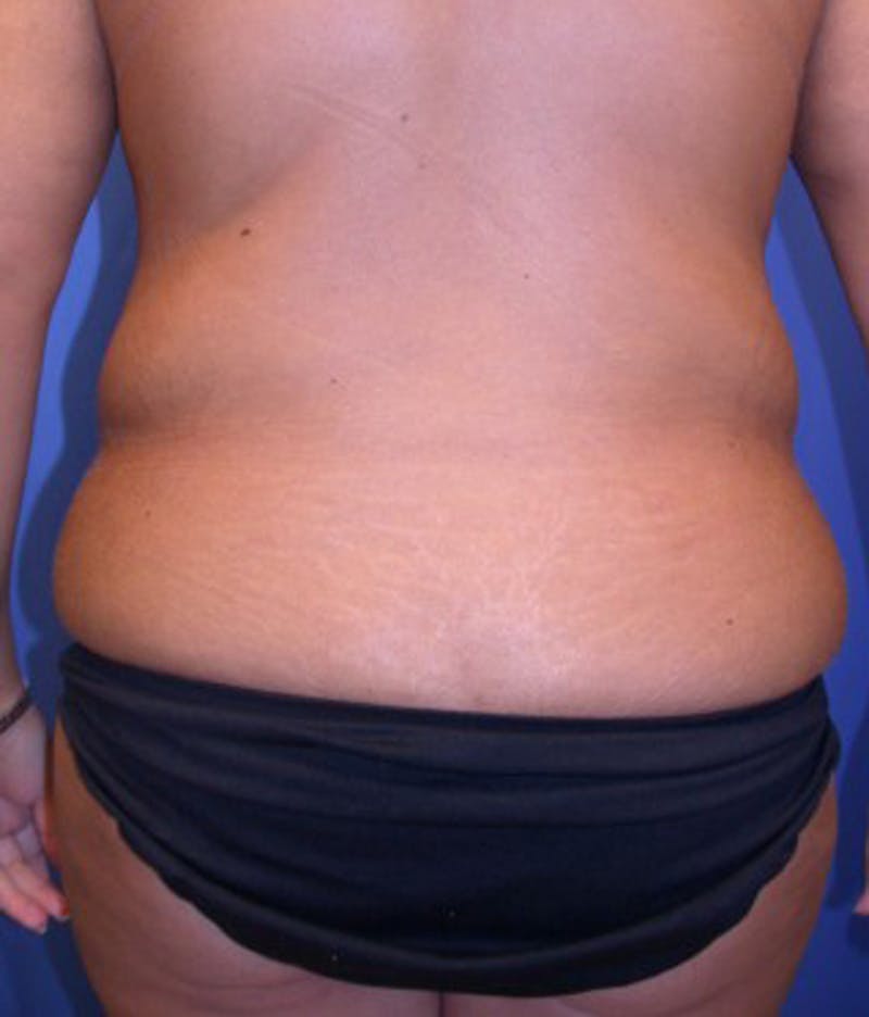 Massive Weight Loss Before & After Gallery - Patient 174163236 - Image 5