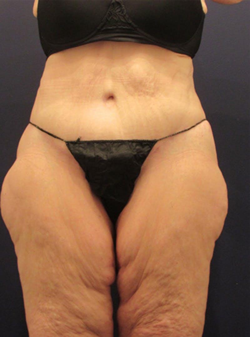 Massive Weight Loss Before & After Gallery - Patient 174163255 - Image 2