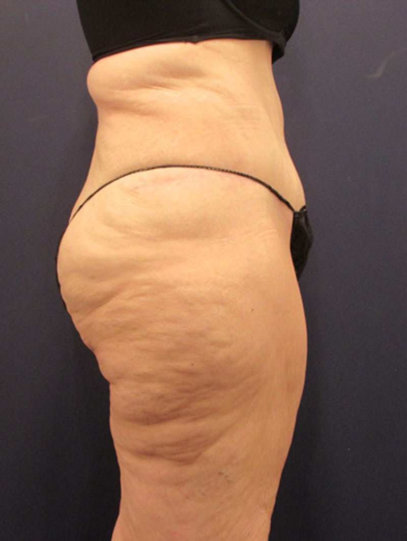 Massive Weight Loss Before & After Gallery - Patient 174163255 - Image 4