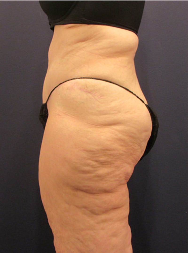 Massive Weight Loss Before & After Gallery - Patient 174163255 - Image 6