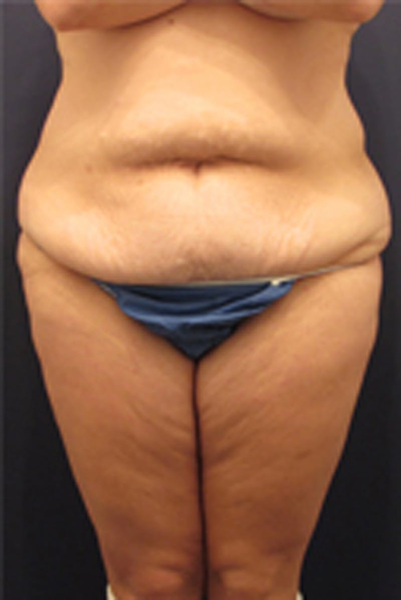 Massive Weight Loss Before & After Gallery - Patient 174163261 - Image 1