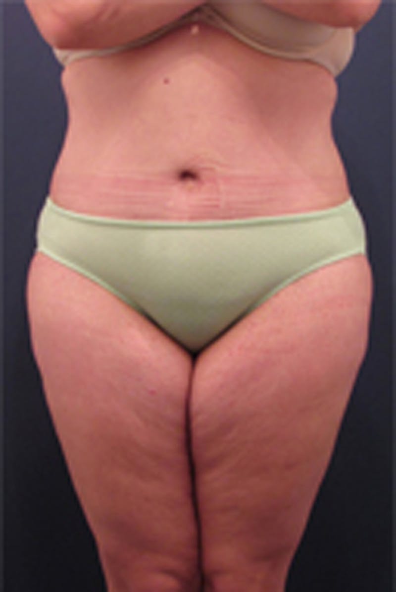 Massive Weight Loss Before & After Gallery - Patient 174163261 - Image 2