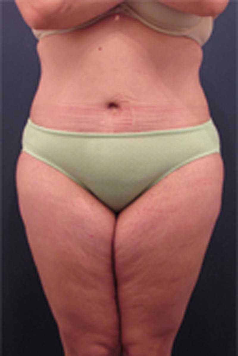 Massive Weight Loss Before & After Gallery - Patient 174163261 - Image 2