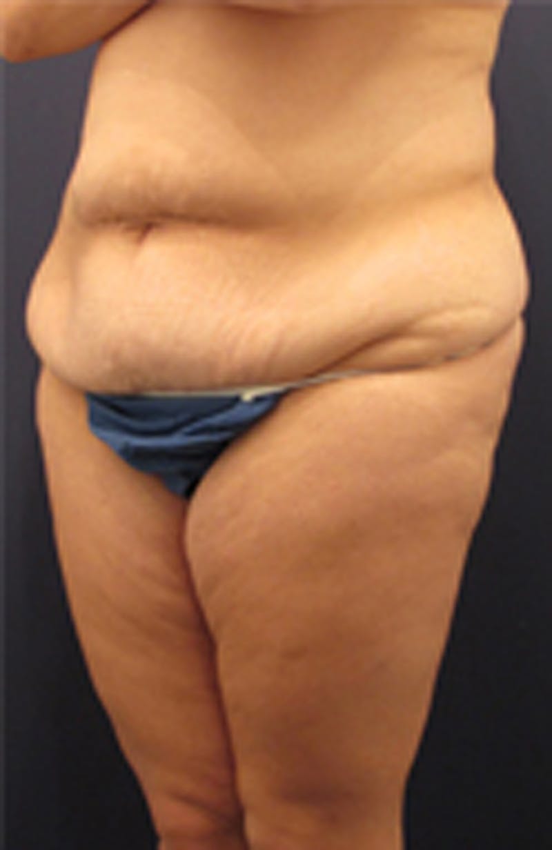 Massive Weight Loss Before & After Gallery - Patient 174163261 - Image 3