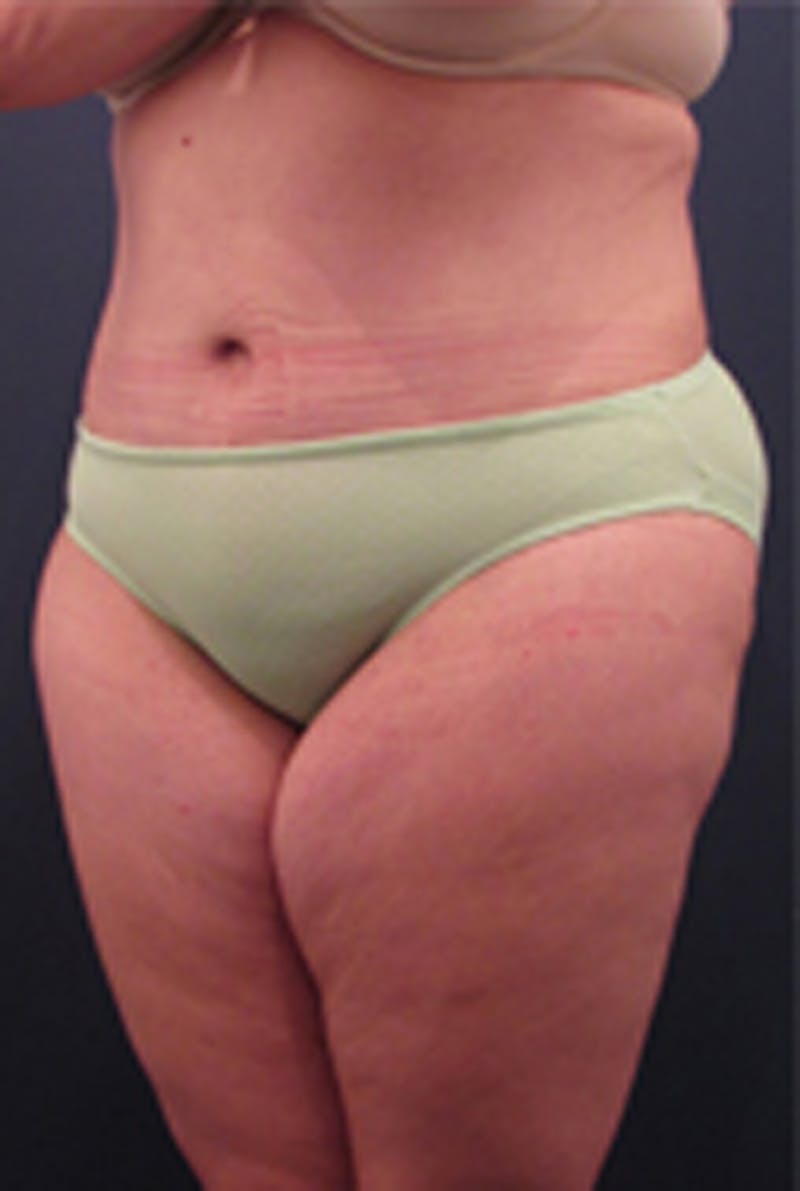 Massive Weight Loss Before & After Gallery - Patient 174163261 - Image 4