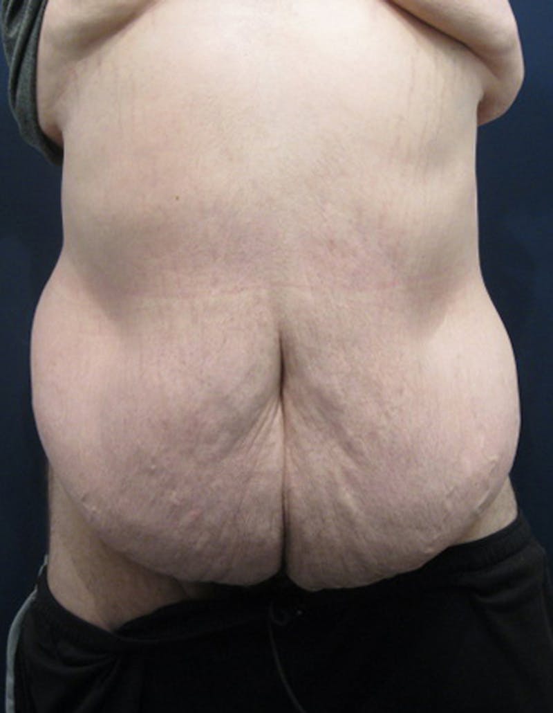 Massive Weight Loss Before & After Gallery - Patient 174163267 - Image 1