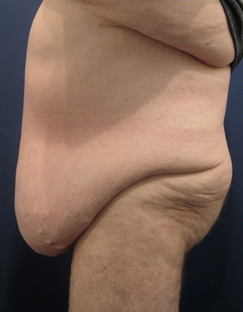 Massive Weight Loss Before & After Gallery - Patient 174163267 - Image 3