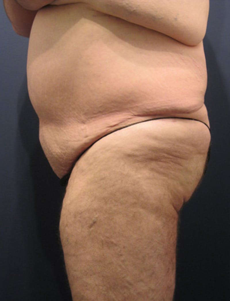 Massive Weight Loss Before & After Gallery - Patient 174163267 - Image 4