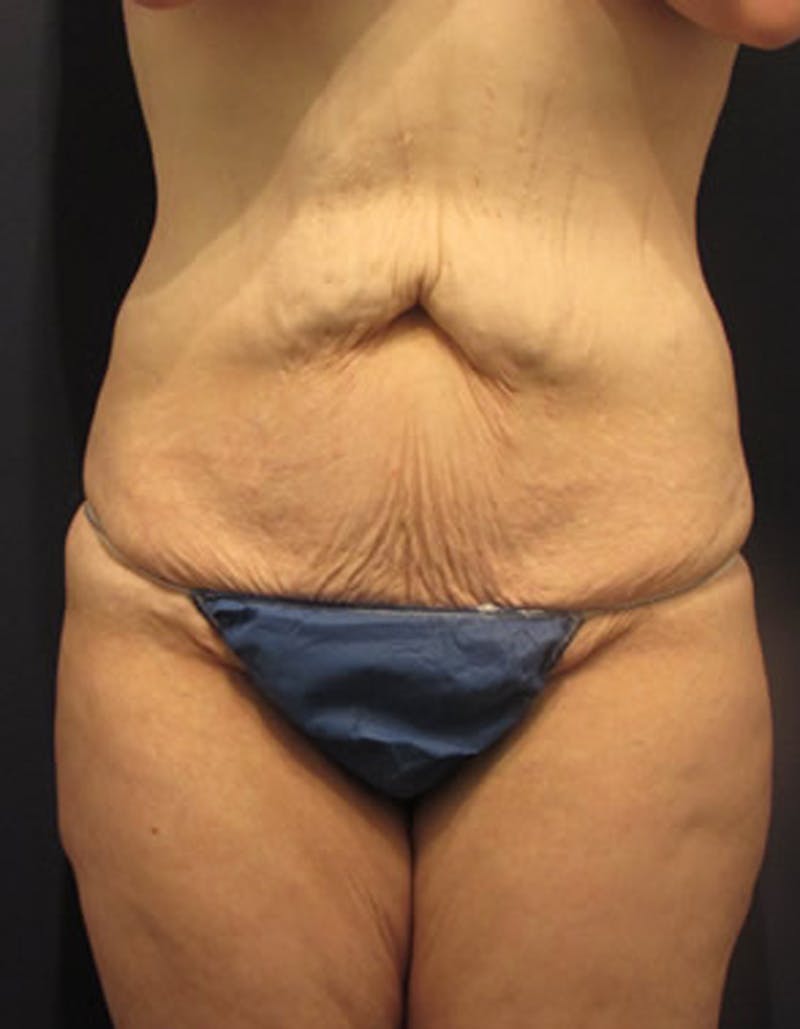 Massive Weight Loss Before & After Gallery - Patient 174163273 - Image 1